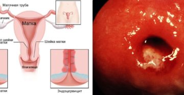 Что такое атрофический цервицит