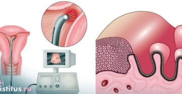 Как лечится гипоплазия эндометрия