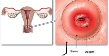 Свечи после прижигания эрозии шейки матки
