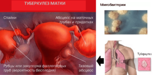 Симптомы туберкулёза матки