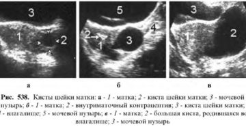 Что такое ретенционные кисты шейки матки