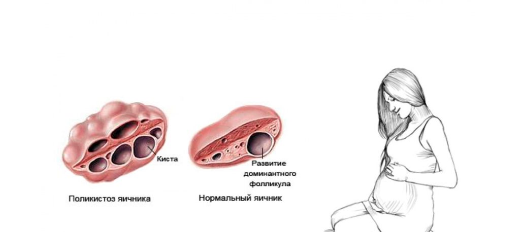 Как похудеть при поликистозе яичников