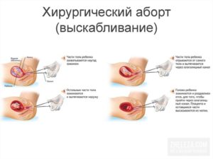 Половая жизнь после выскабливания