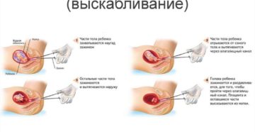 Половая жизнь после выскабливания