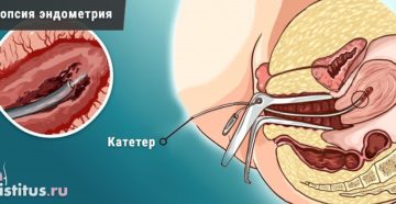 Как делают пайпель биопсию эндометрия