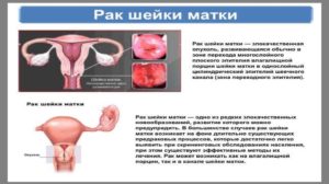 От чего бывает рак шейки матки