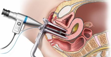 Чем отличается гистероскопия от гистерорезектоскопии