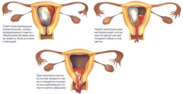 Когда приходят месячные после выкидыша