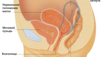 Причины и последствия отклонения матки