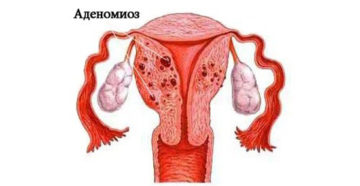 Что такое очаговый аденомиоз матки