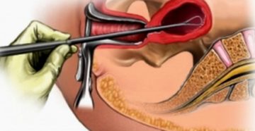 Что такое гистология в гинекологии после выскабливания