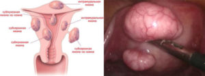 Можно ли делать эко при миоме матки