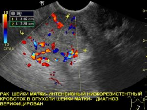 Виден ли на УЗИ рак матки и шейки матки