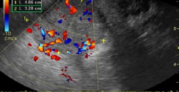 Виден ли на УЗИ рак матки и шейки матки