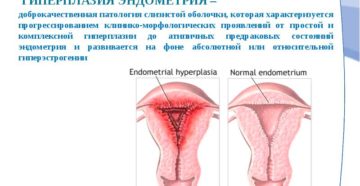 Что такое гиперплазия эндометрия