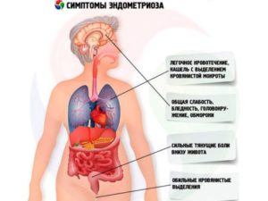 Эндометриоз симптомы и лечение при климаксе