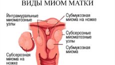 Что такое миоматозный узел матки