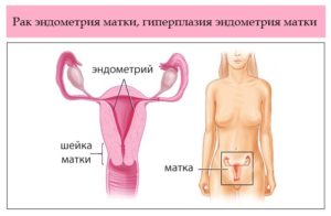 Рак шейки матки психосоматика