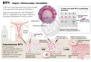 Hpv инфекция у женщин что это