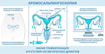 Методика гистеросальпингографии рисунок