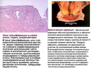 Что называют хроническим цервицитом шейки матки