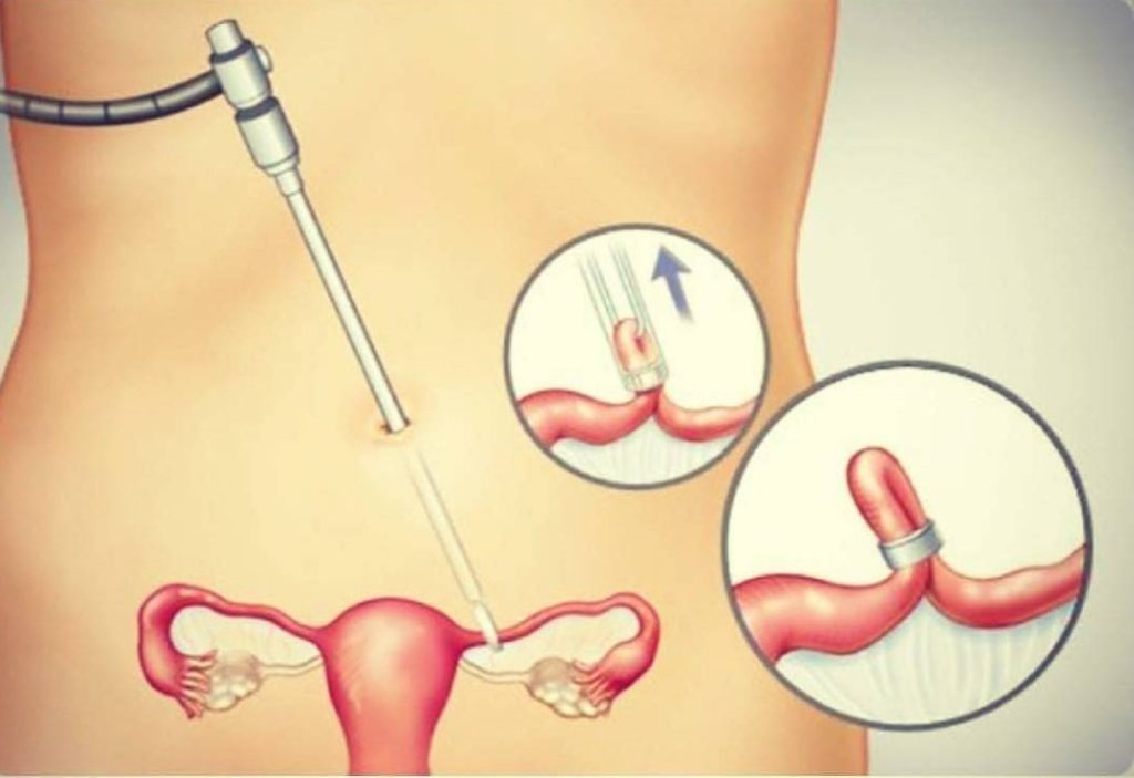 Как перевязывают трубы у женщин