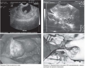 Анэхогенная киста яичника