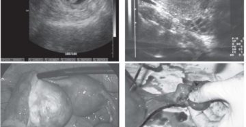 Анэхогенная киста яичника