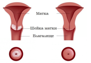 Пятна на шейке матки