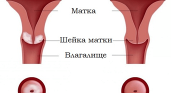 Пятна на шейке матки