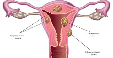 Лечение миомы матки небольших размеров