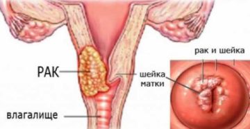 Причины увеличения матки у женщин