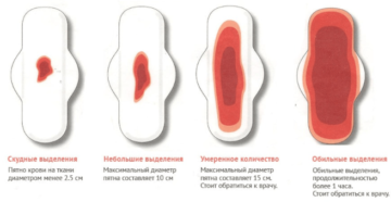 Обильные месячные как уменьшить кровотечение