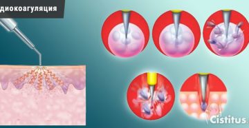 Что называют радиоволновой коагуляцией шейки матки