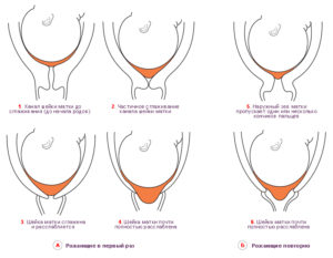 Что означает мягкая шейка матки