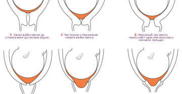 Что означает мягкая шейка матки