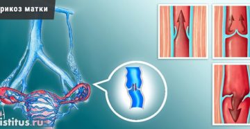 Лечение варикозного расширения вен матки