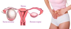 Что делать при кисте яичника в менопаузе