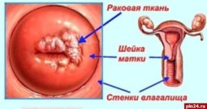 Эрозия шейки матки и вирус папиллома человека