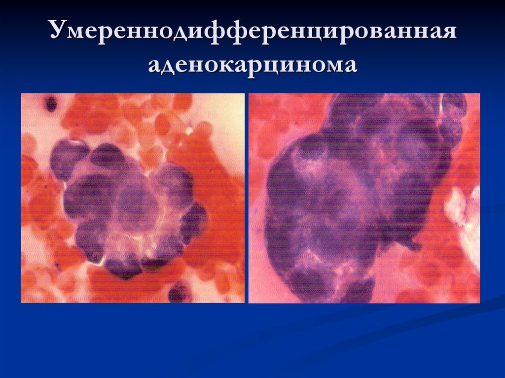 Умеренно дифференцированная аденокарцинома матки