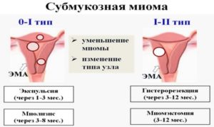 Субмукозная разновидность миомы матки