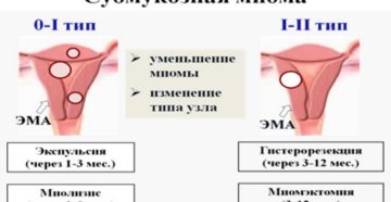 Субмукозная разновидность миомы матки