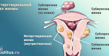 Интерстициальный узел что это такое