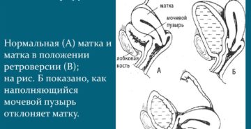 Загиб матки кпереди