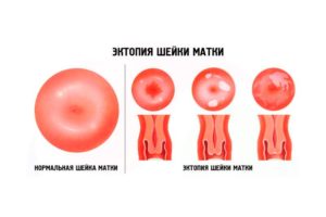 Эктопия цилиндрического эпителия шейки матки