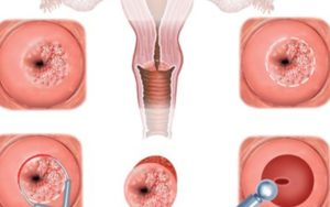 Последствия лечения эрозии шейки матки