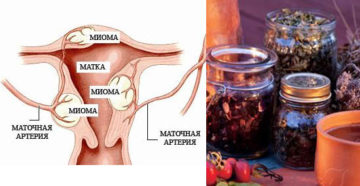 Как лечить субмукозную миому матки народными средствами