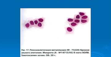 Что такое плоскоклеточная метаплазия