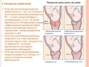 Раскрытие шейки матки как ускорить