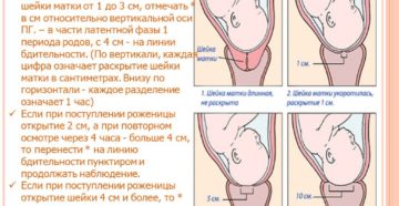 Раскрытие шейки матки как ускорить